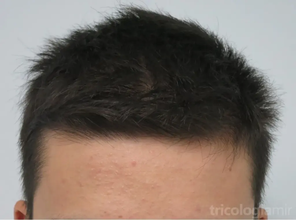 Caso de varón joven con alopexia: importante preocupación con pelo “normal”.