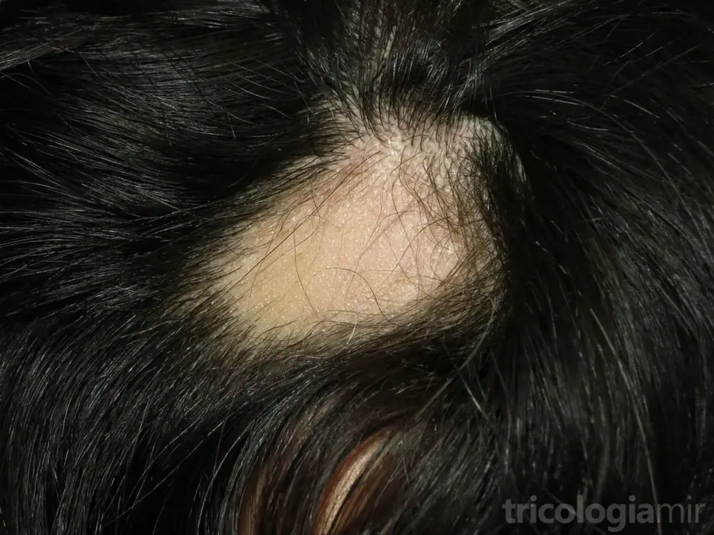 Placa única de alopecia areata.