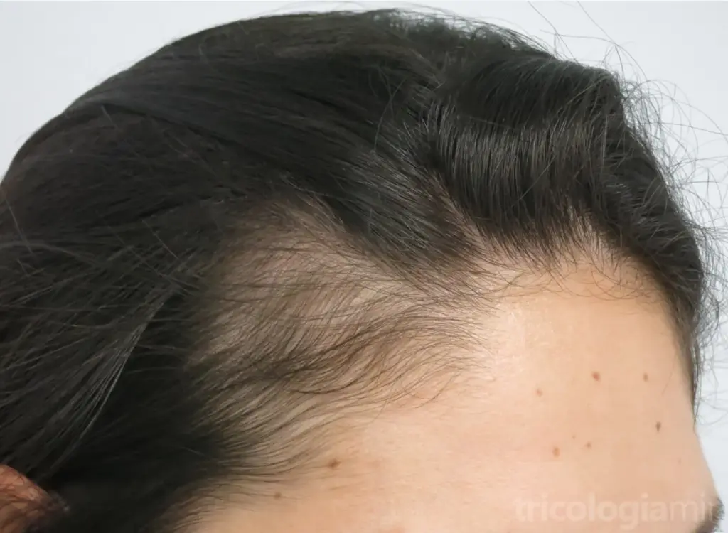 Entradas típicas asociadas a episodio de efluvio telógeno agudo.