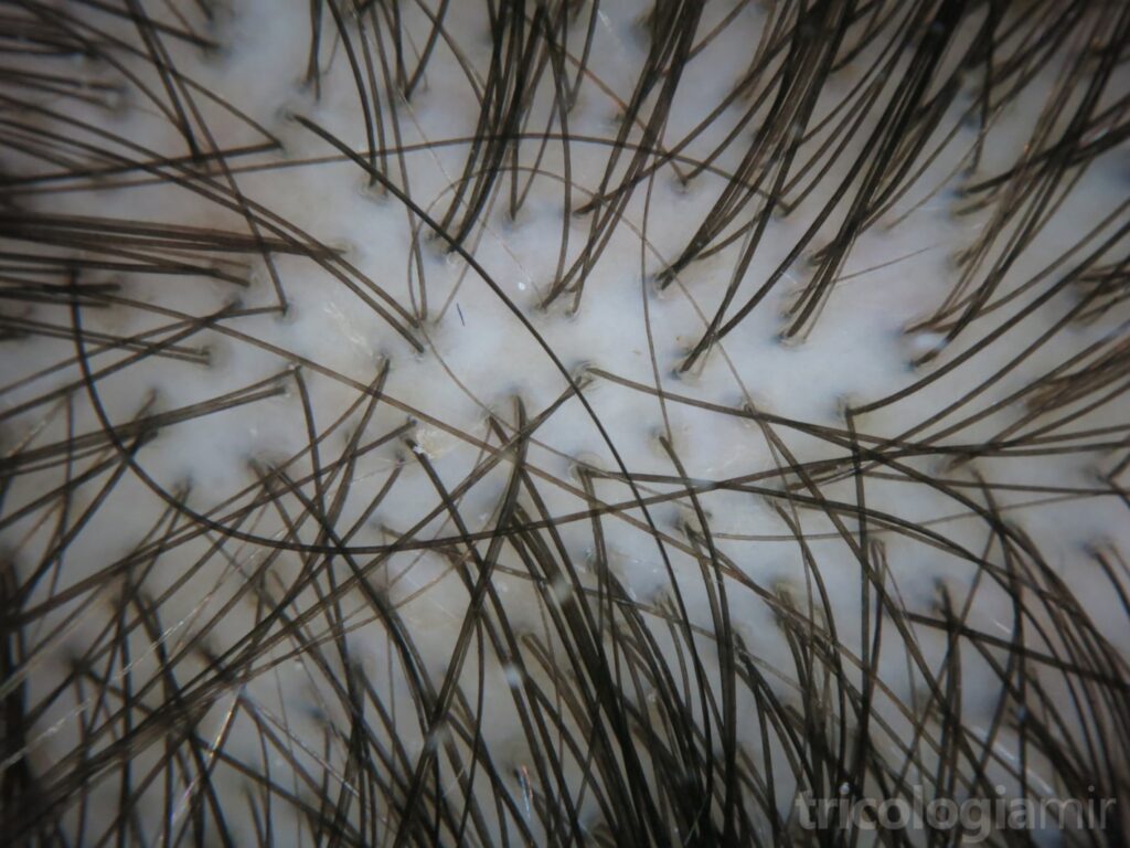 La dermatoscopia del efluvio telógeno es totalmente normal