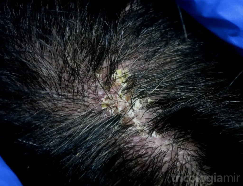 Foliculitis decalvans en fase de brote con intenso eritema y múltiples costras amarillentas