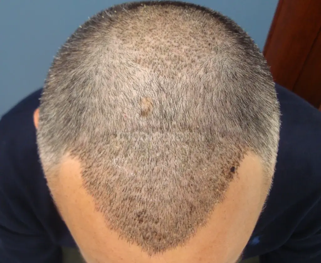 Zonas receptoras (frontal y coronilla) tras 6 días de la intervención