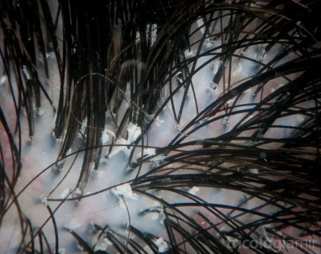 Tricoscopia de un LPP con eritema discreto, hiperqueratosis folicular y pelos en penacho