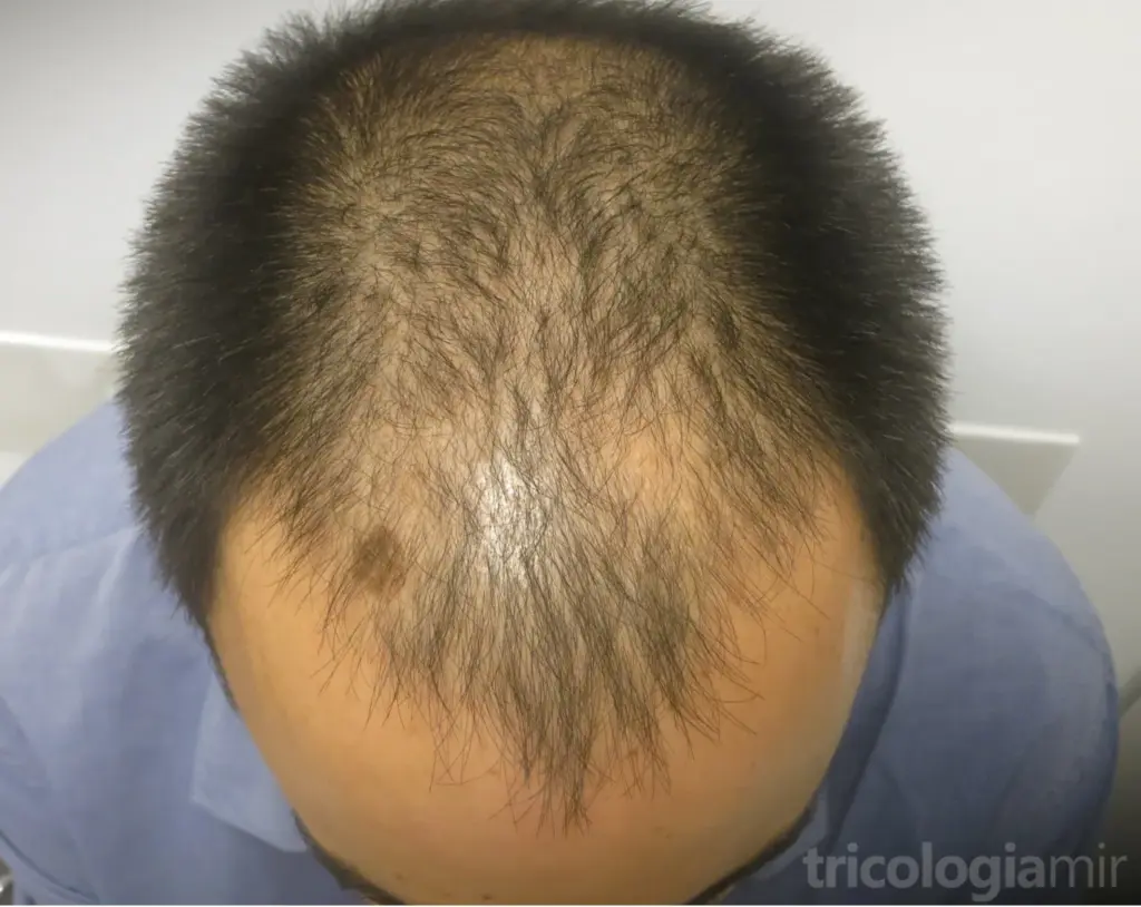 MAGA grado IV antes de realizar tratamiento