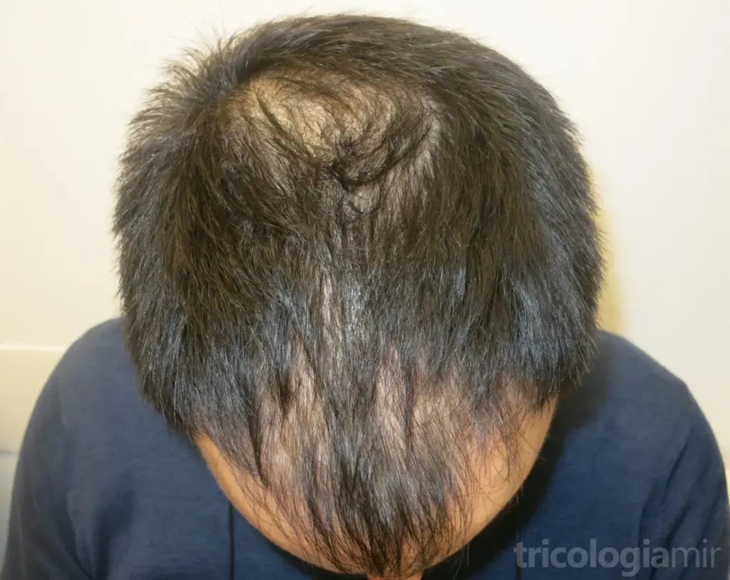 Mejoría notable a los 3 meses de una sola sesión de mesoterapia de Dutasteride