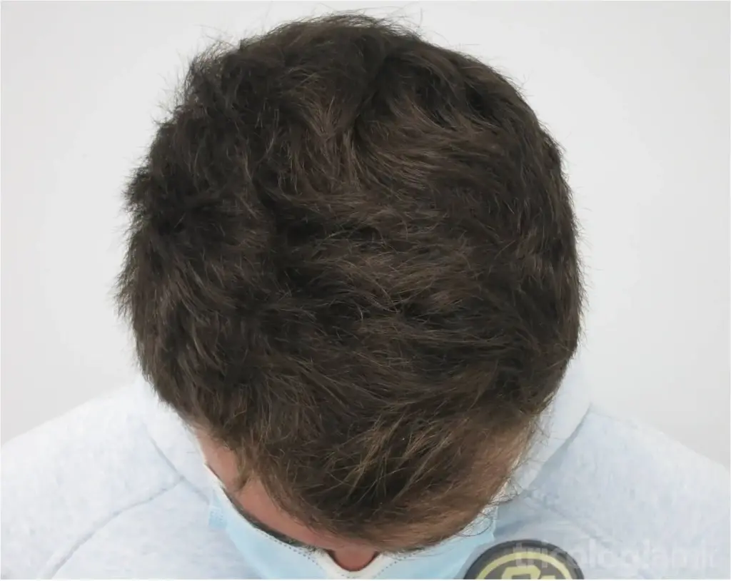 Mejoría notable tras 6 meses de tratamiento con Minoxidil oral 5mg/día