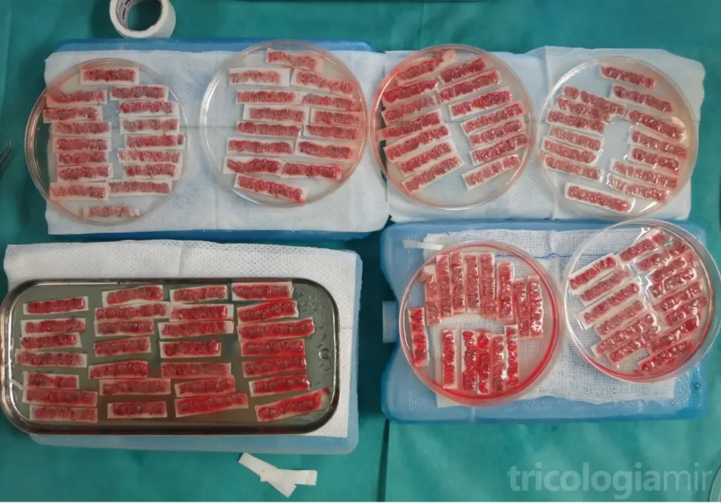 Unidades foliculares separadas una a una y preparadas para implantar